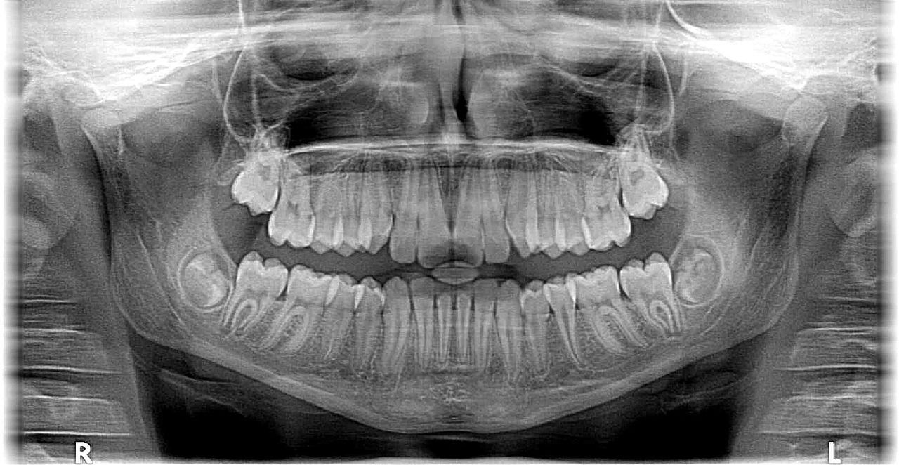 W jaki sposób można uratować poważnie uszkodzone zęby?